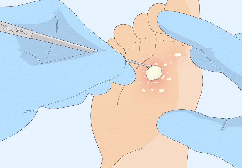 How to Get Rid of a Mosaic Wart: Home Remedies & Treatment