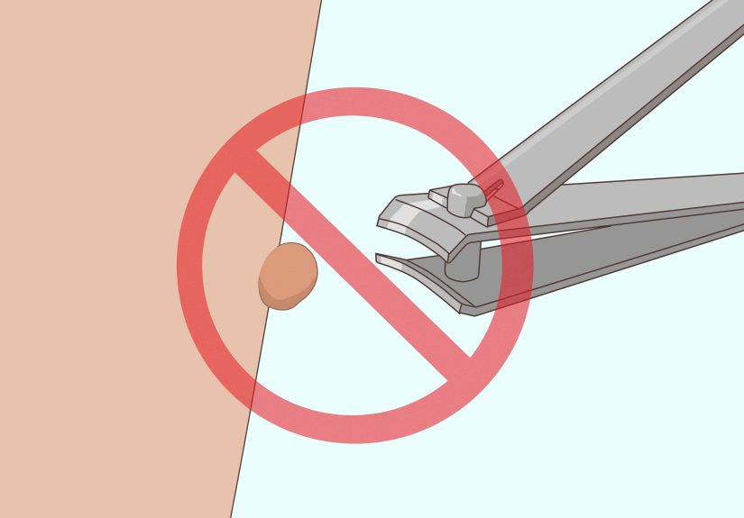 How to Stop Warts from Bleeding: 7 Steps