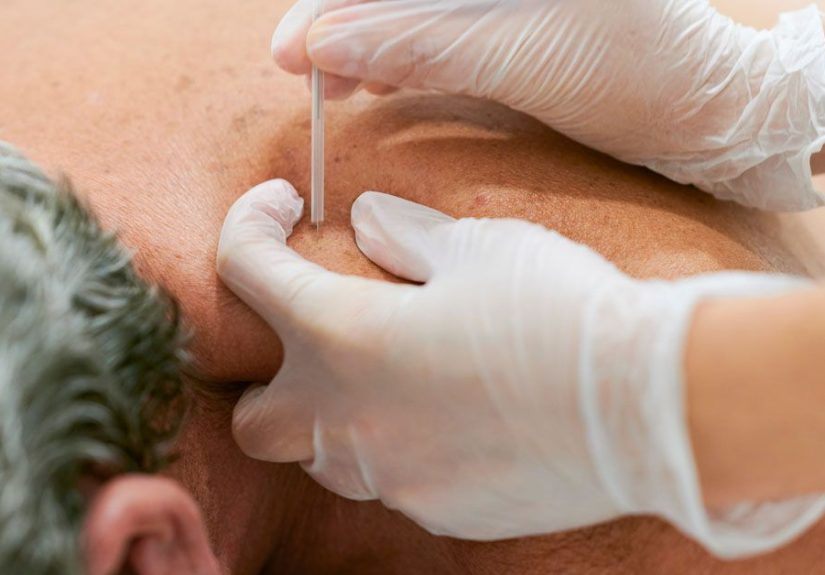 Medicare Coverage: Acupuncture for Neuropathy