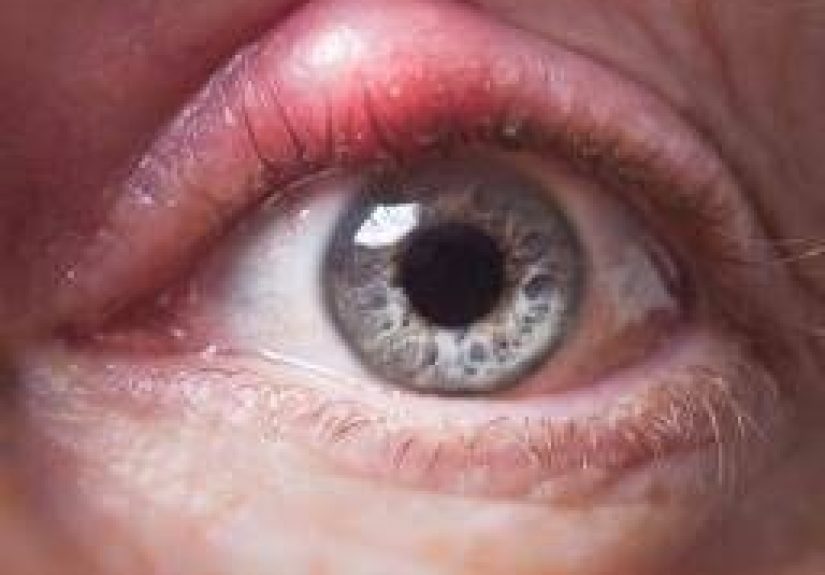 Orzuelos: causas, prevención y tratamientos