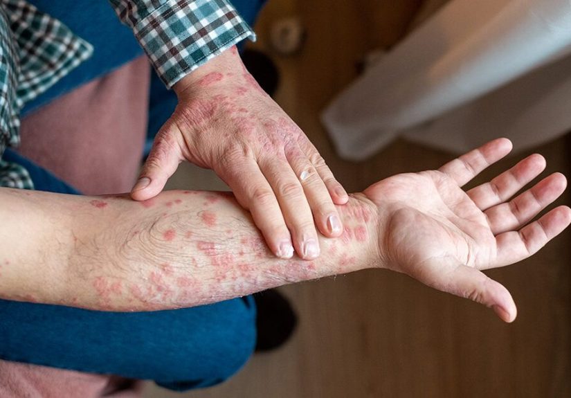 Psoriasis Treatment Timeline: Your FAQs Answered