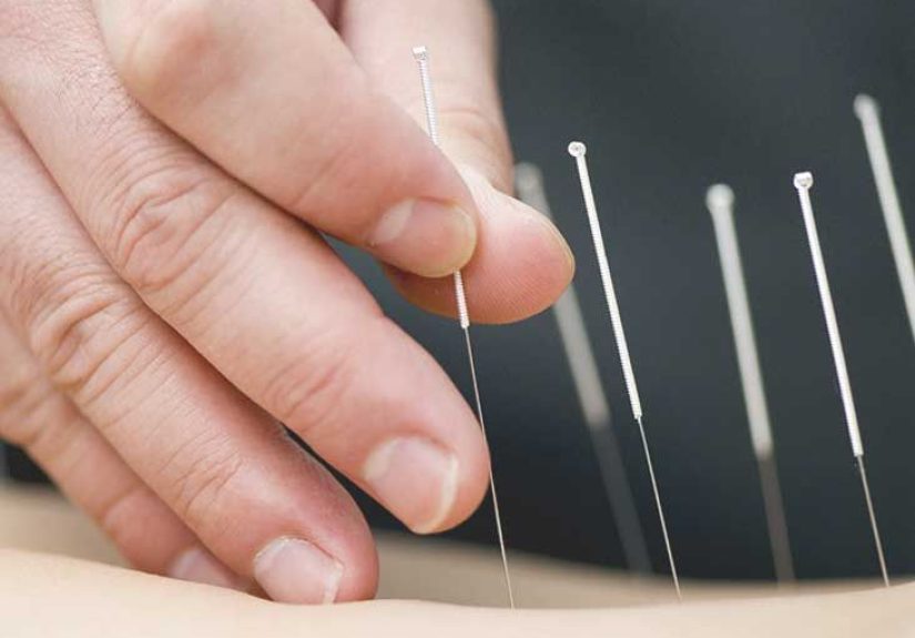 Acupuncture for Back Pain: Does it Work?