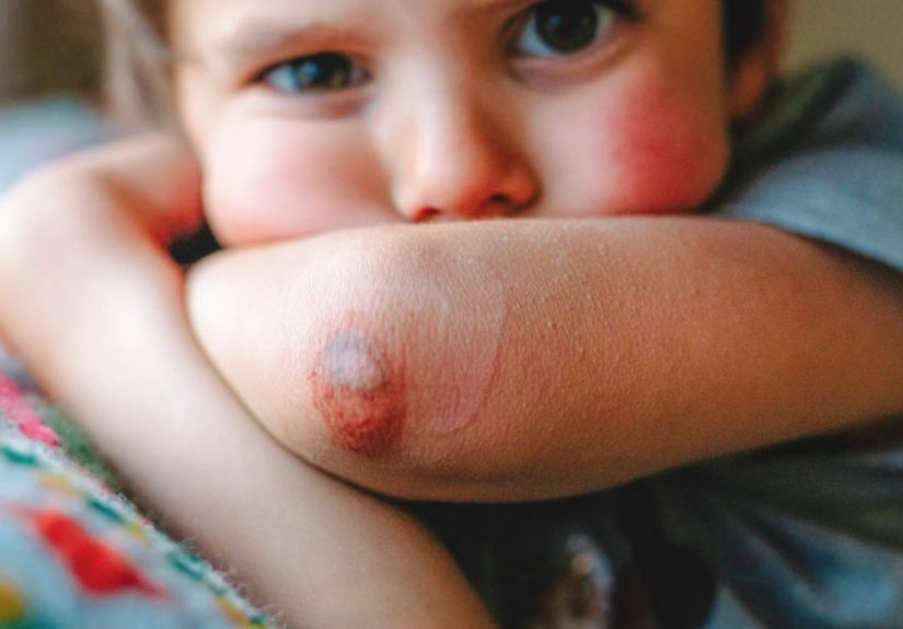 Bruised Elbow: Causes, Symptoms, Treatment, and Healing Time