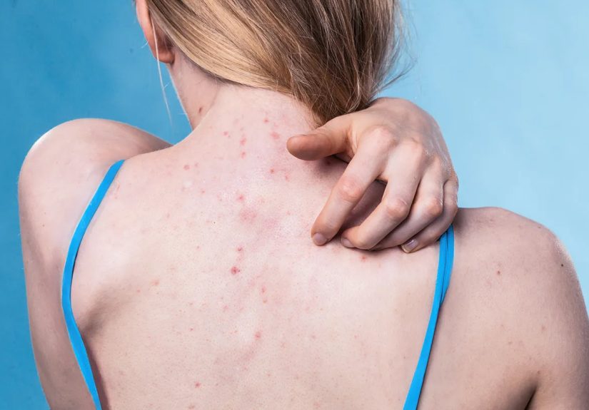 Dermatillomania: What Causes Skin-Picking Disorder and How to Treat It