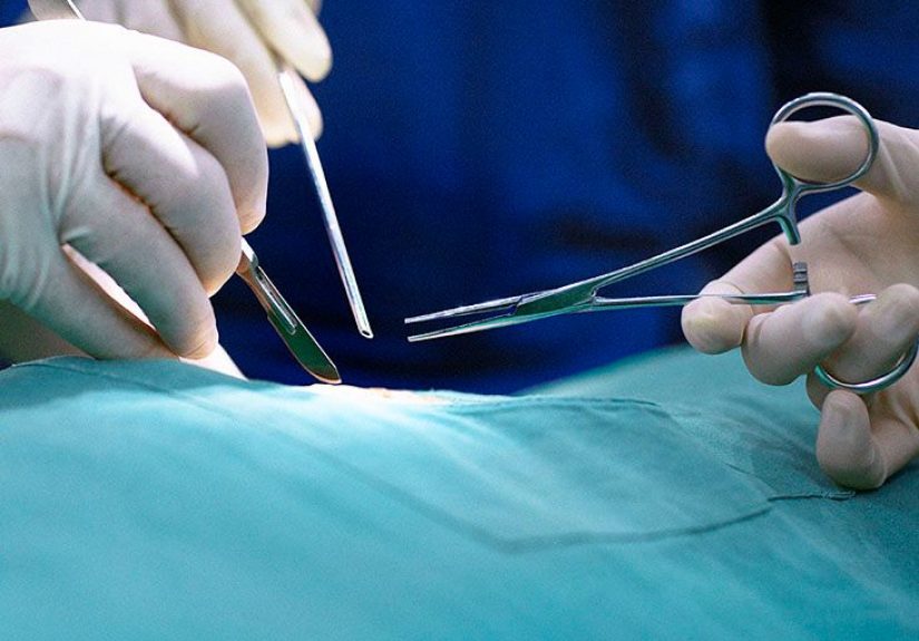 Fundoplication: Uses, What to Expect, and More