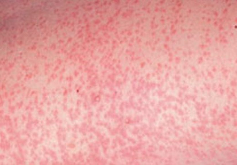 German Measles (Rubella): Causes, Symptoms, and Treatments