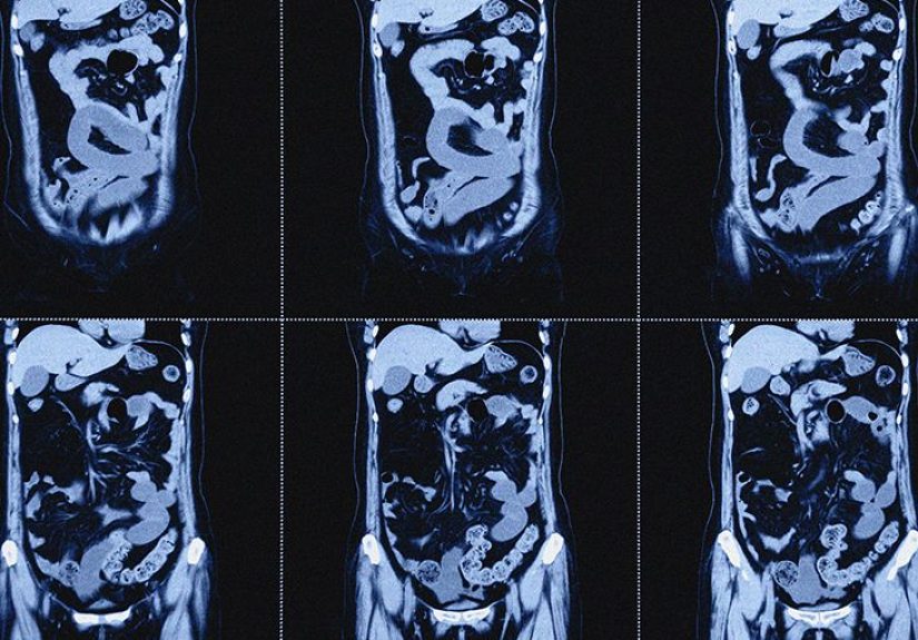 How long are your intestines? Length of small and large intestine