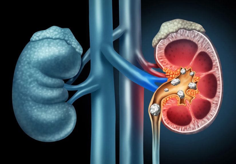 Kidney Stones: Types, What To Expect When You Pass Them, & More