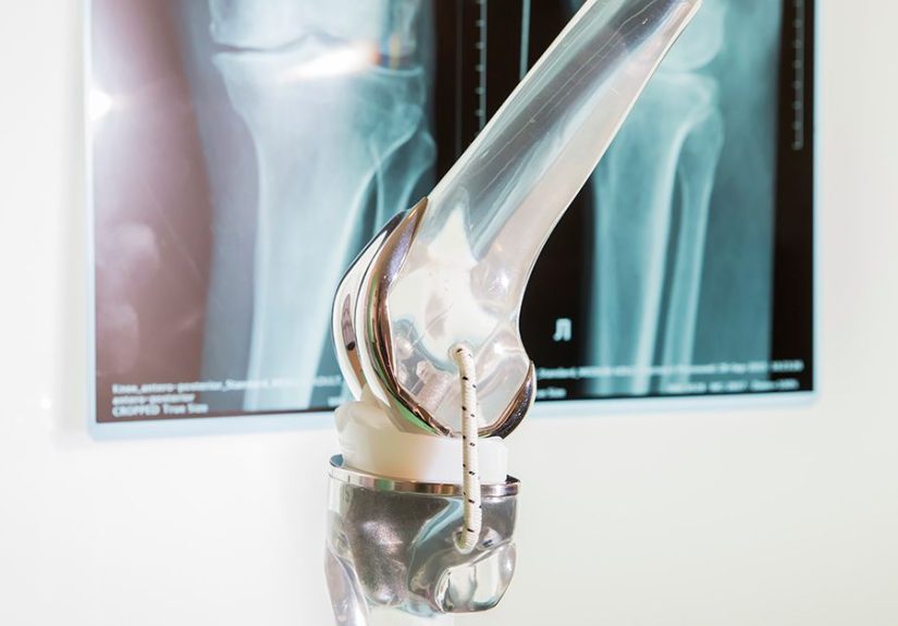 Knee Replacement Implants: How to Choose What's Right for You