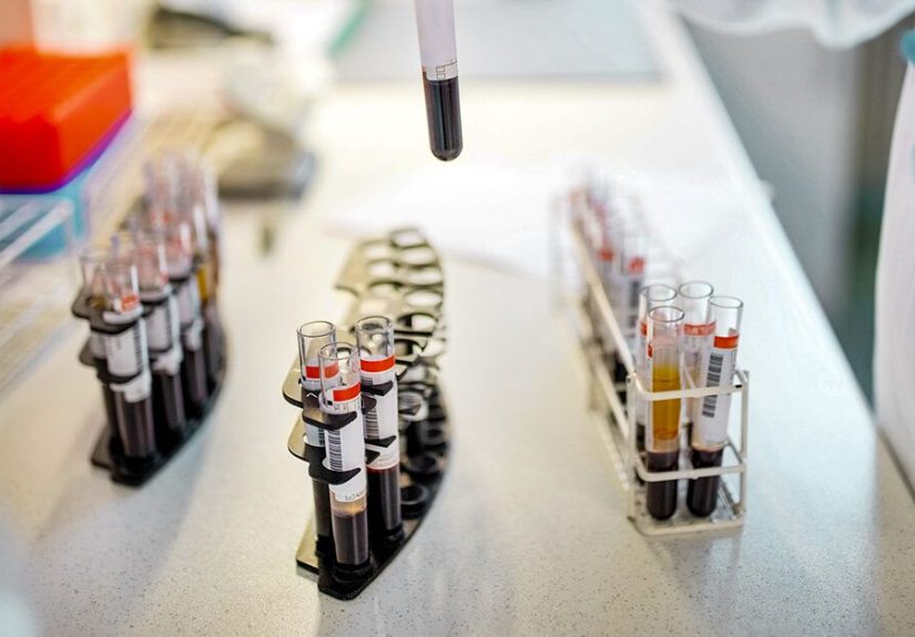 Lymphocytosis with Smudge Cells: Definition and Causes