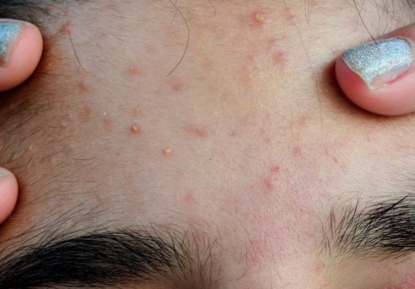 Managing Itchy Acne: Symptoms, Causes, and Treatment