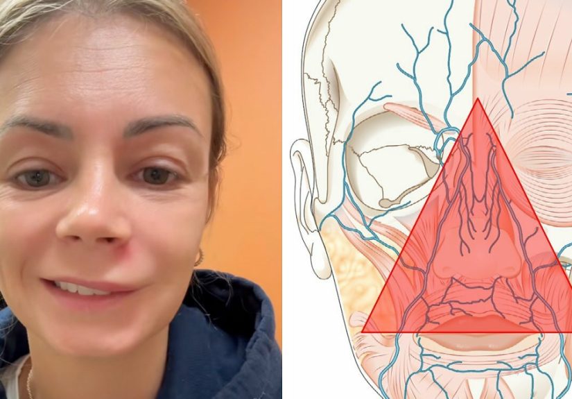 Mom Ends Up in Urgent Care After Popping Pimple In The &ldquo;Triangle Of Death&rdquo;&mdash;Here's Why Doctors Warn Against It