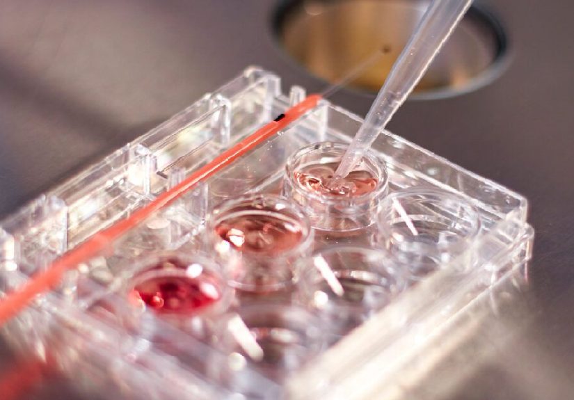 Multiple Myeloma Hypercalcemia: Causes, Symptoms, Treatment & More