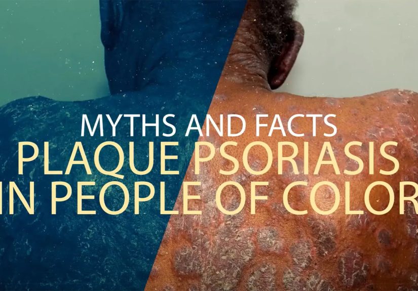 Myths & Facts: Plaque Psoriasis in People of Color