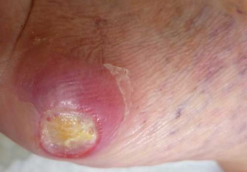 Pictures of Diabetic Neuropathy