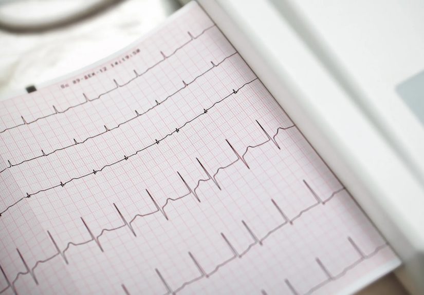 Rapid Dementia Onset Linked to Atrial Fibrillation in Women