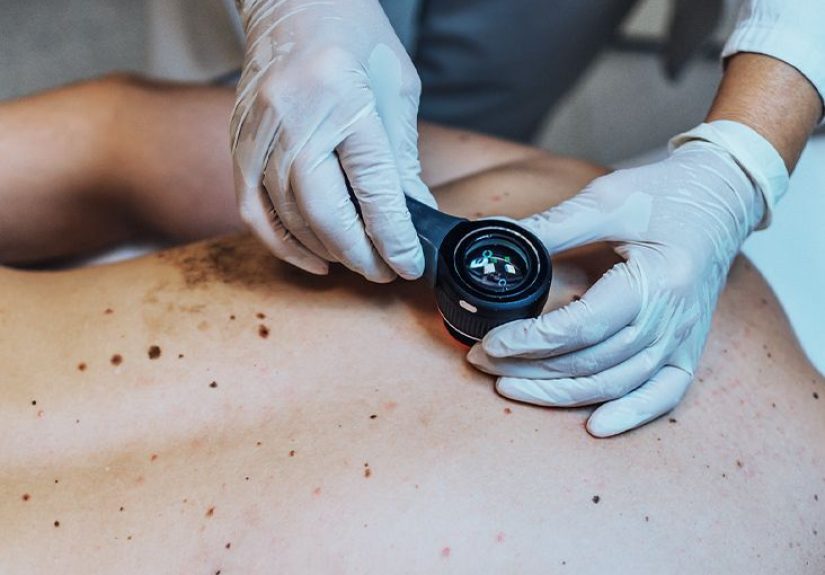 Stages of Squamous Cell Carcinoma and Prognosis