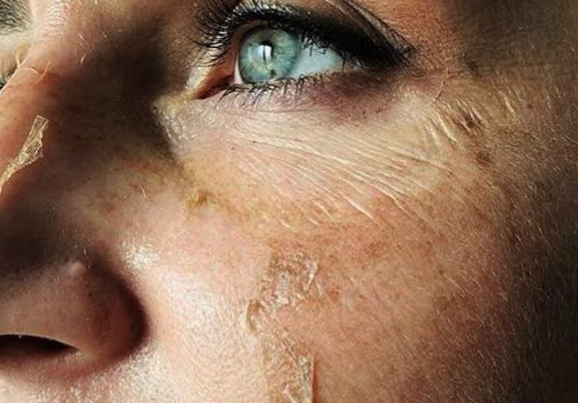 The Perfect Peel: How Does It Resurface Your Skin & Is It Worth It?