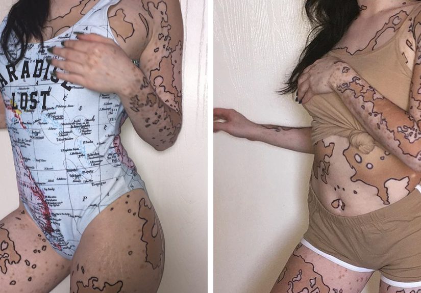 After Being Bullied For Vitiligo All Her Life, This Girl Now Turns Her Body Into Amazing Art
