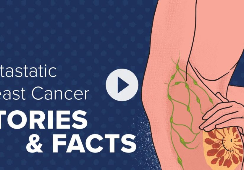 Breast Cancer Videos from Medical News Today