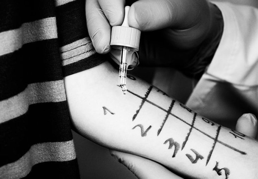 Children with eczema at higher risk for allergic contact dermatitis