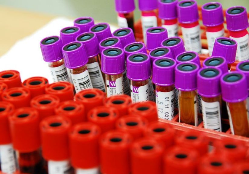 Complement Test: Types, Procedure, and Results