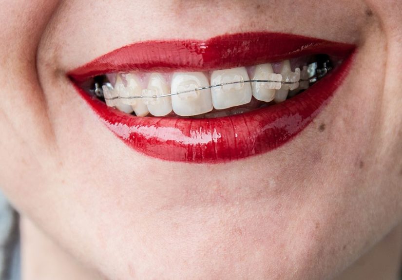 Damon Braces: How They Work, Vs. Traditional Braces, Cost & More