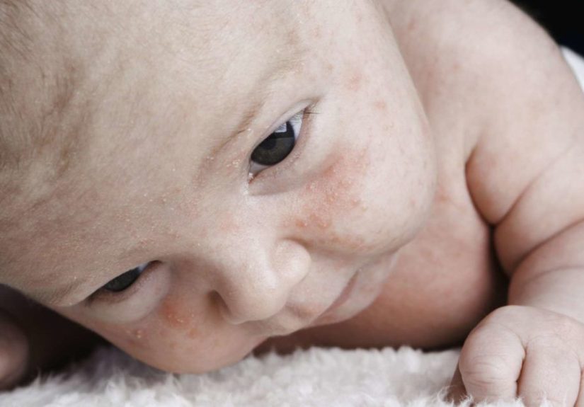 Dry skin on a baby's face: Causes and remedies