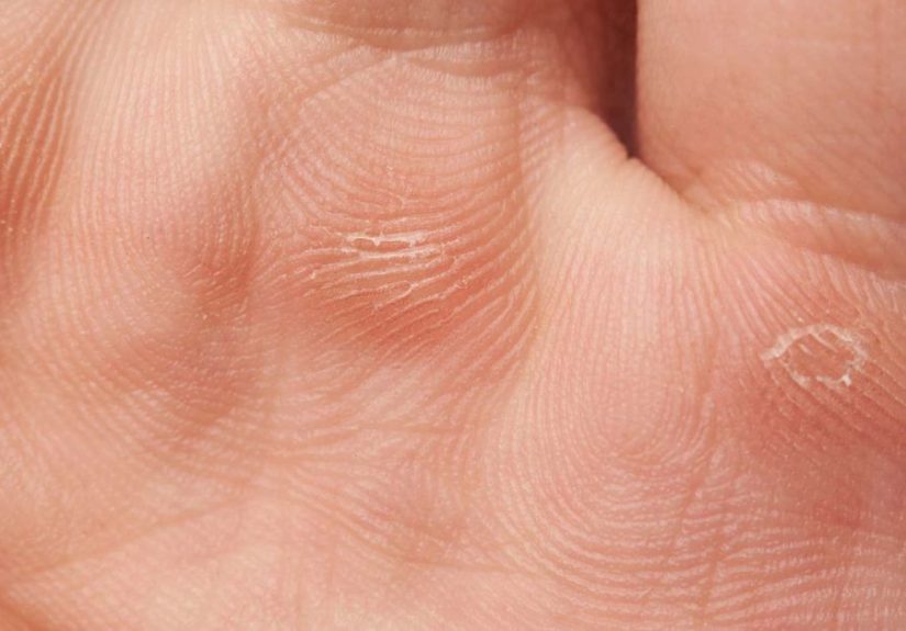 Epidermolysis bullosa: Effects, types, and symptoms