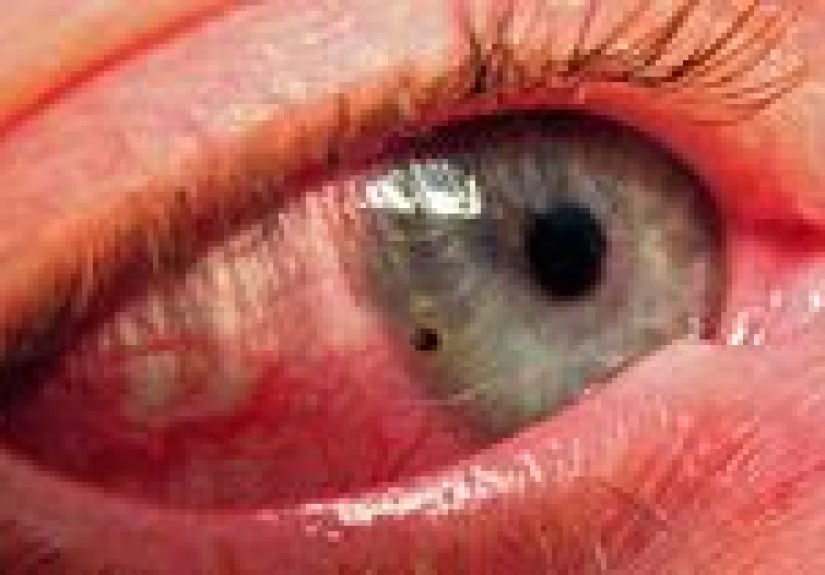 Foreign Object in the Eye: Causes, Symptoms, and Prevention
