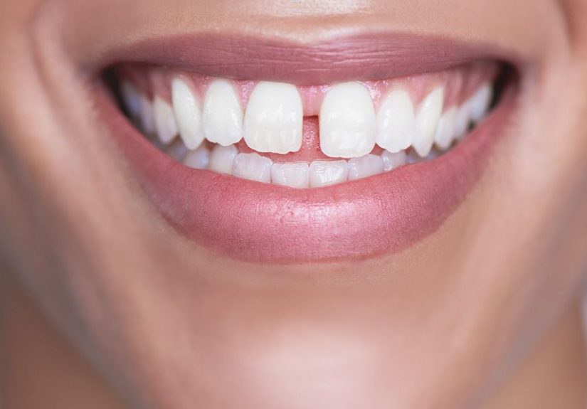 Gingivectomy: What to Expect, Recovery, Cost, and More