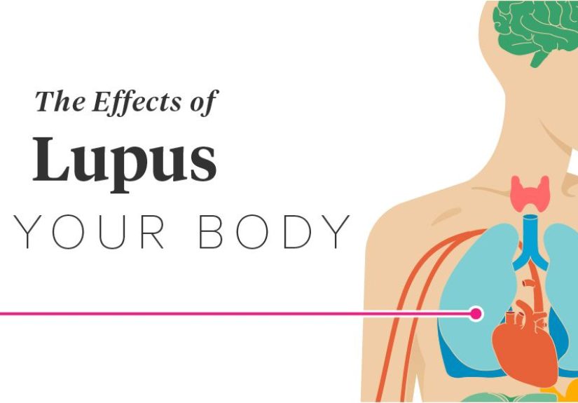 How Does Lupus Affect the Body?