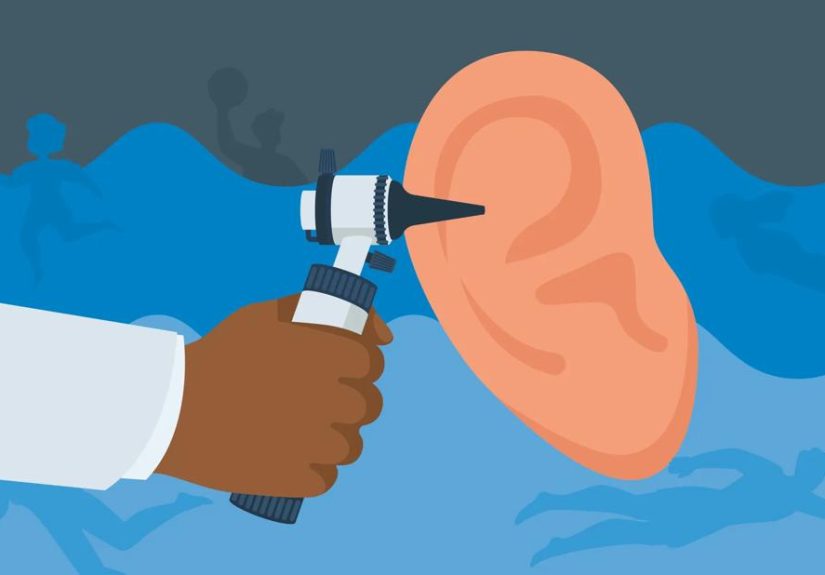 How To Prevent and Get Rid of Swimmer’s Ear
