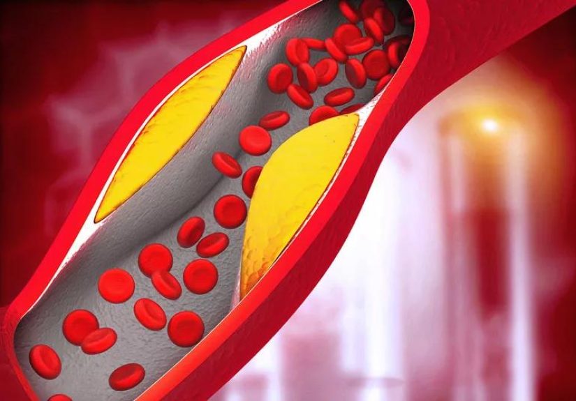 Is High Cholesterol Hereditary?