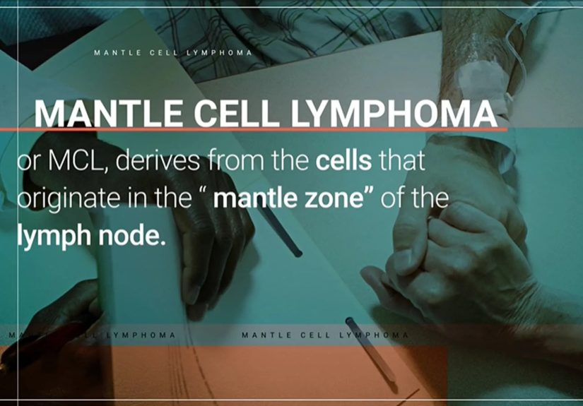 Mantle Cell Lymphoma