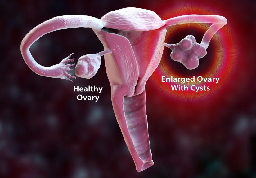 PCOS and Endometrial Cancer: Understanding the Link