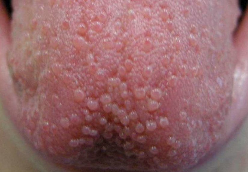 Protuberancias en la lengua: Causas y tratamientos