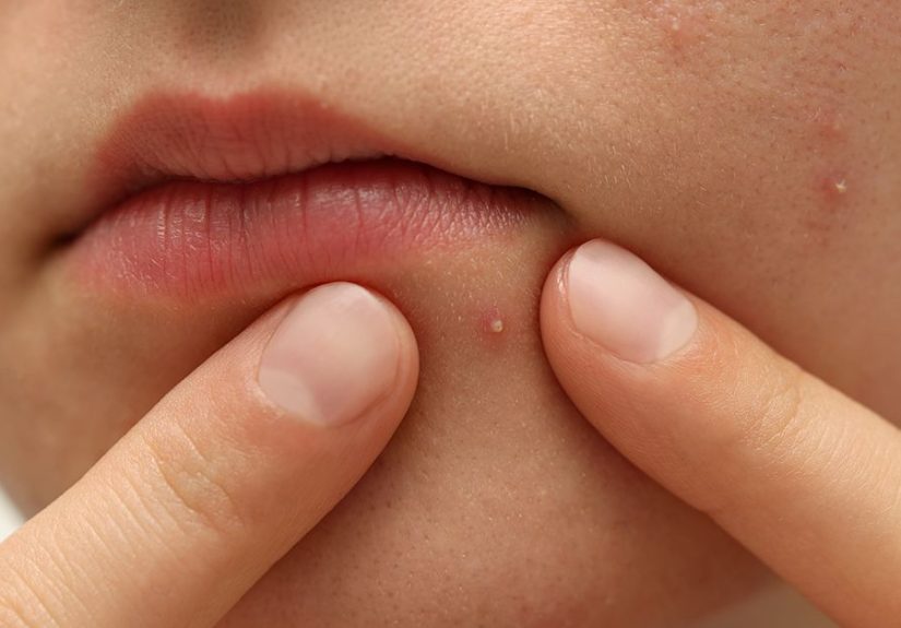 Pustules: Causes, Identification, and Treatments