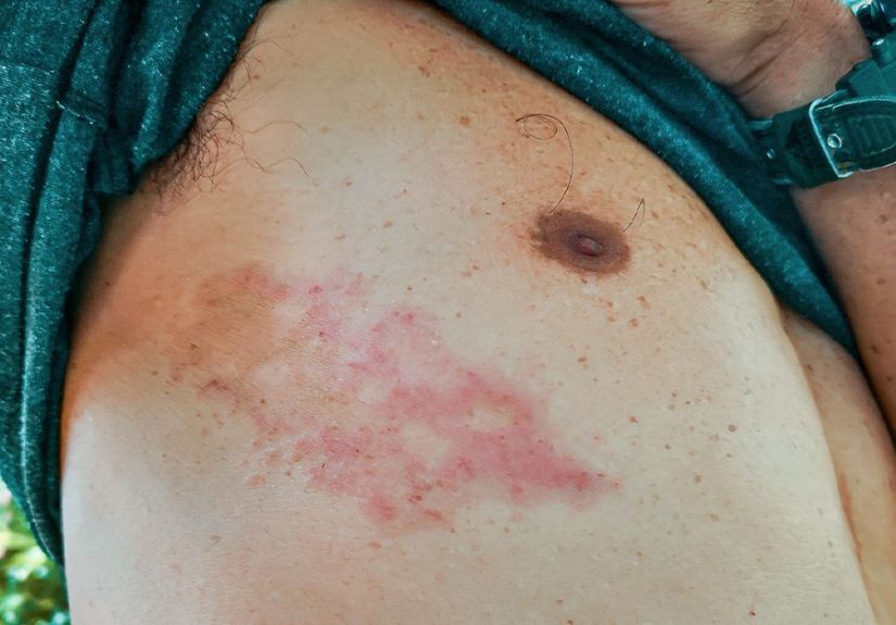 Shingles Recurrence: What You Should Know