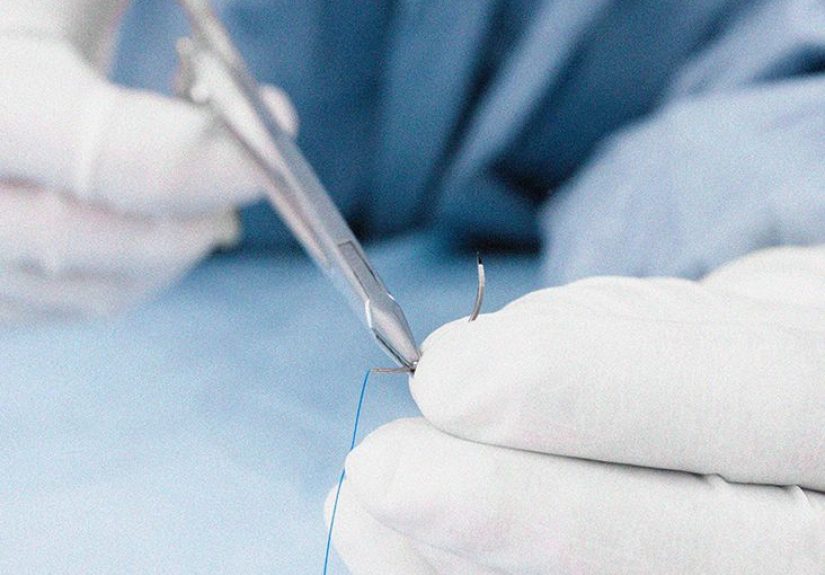 Tongue stitches: Aftercare, healing times, and when to seek help