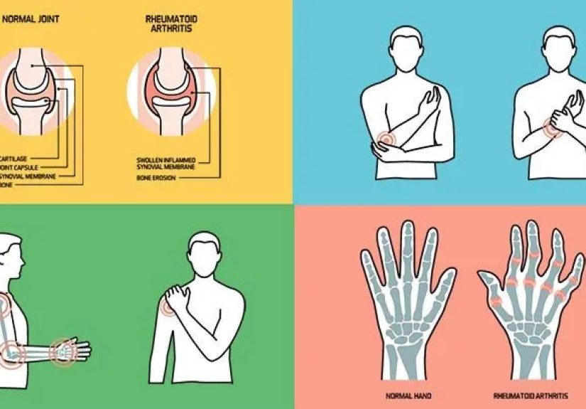 What Is Rheumatoid Arthritis? Symptoms, Causes, Diagnosis, Treatment, and Prevention