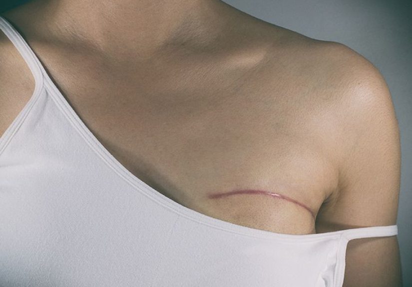 Breast Cancer Treatment: Surgery, Radiation, and More