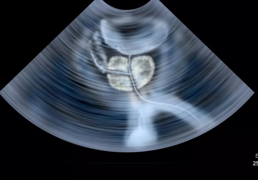 Can an Ultrasound Help Fight Prostate Cancer?