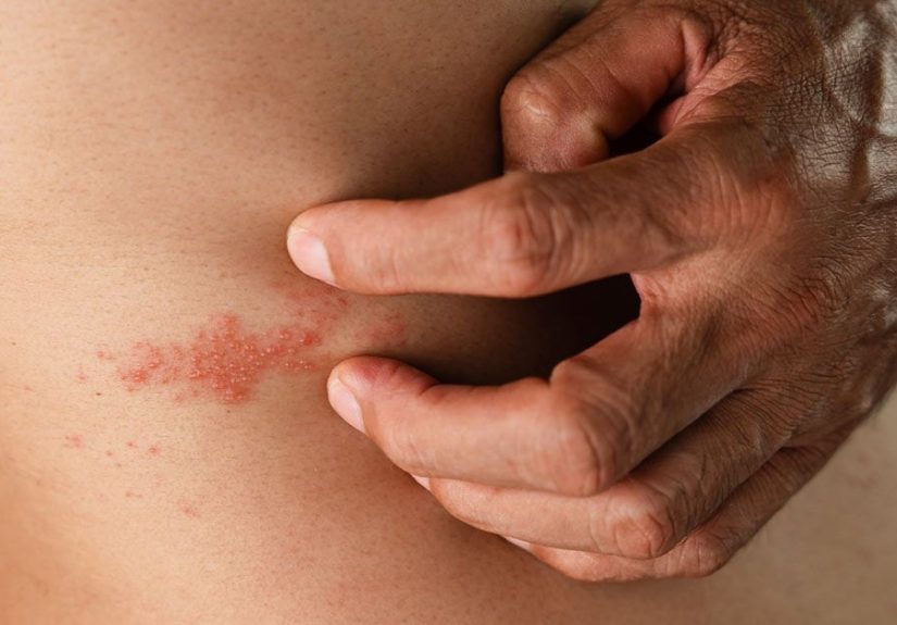 Colon Cancer and Shingles: Research, Risk, Prevention