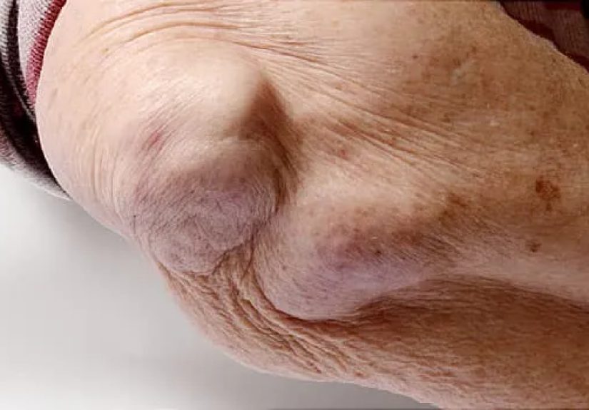 Conditions That Affect Your Bones