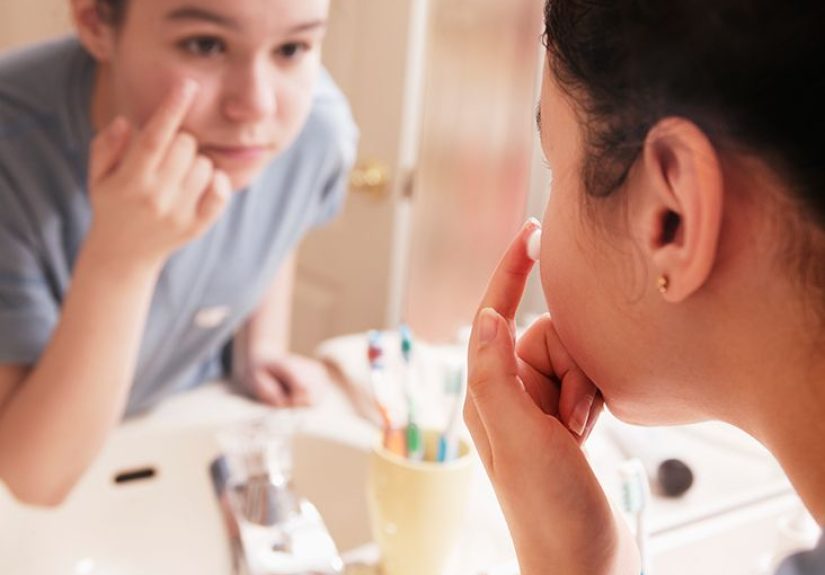 Dry skin and acne: Treatments and home remedies