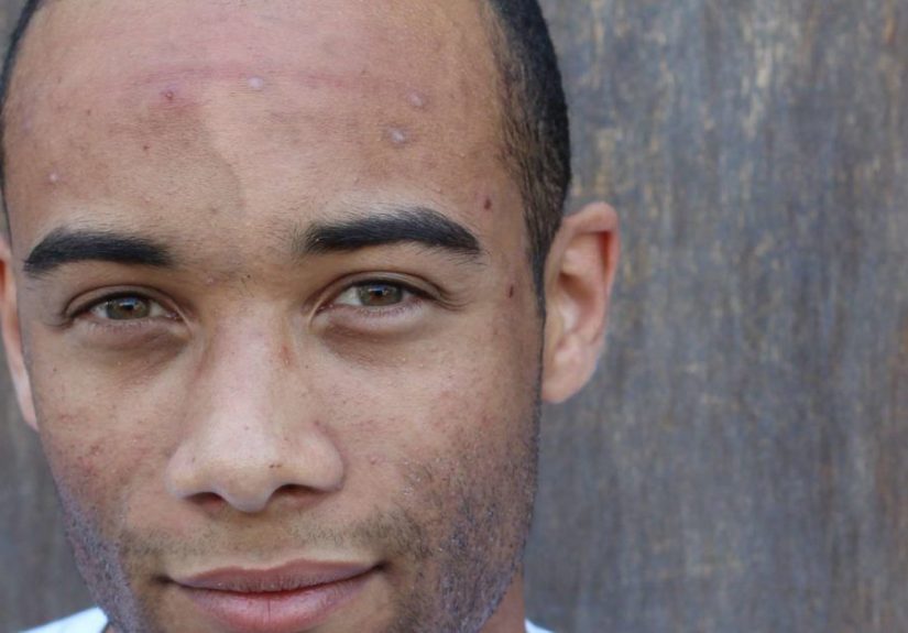 How to get rid of dark spots on black skin