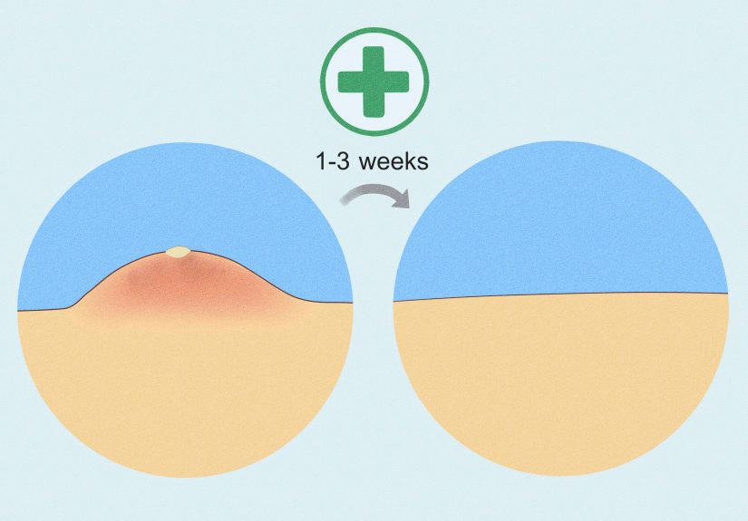 How to Treat Boils: Remedies, Causes, Symptoms & Prevention