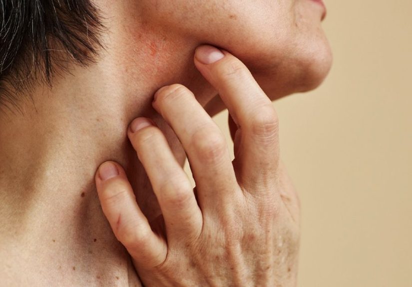 Is Lichen Planus Dangerous? And Other FAQs