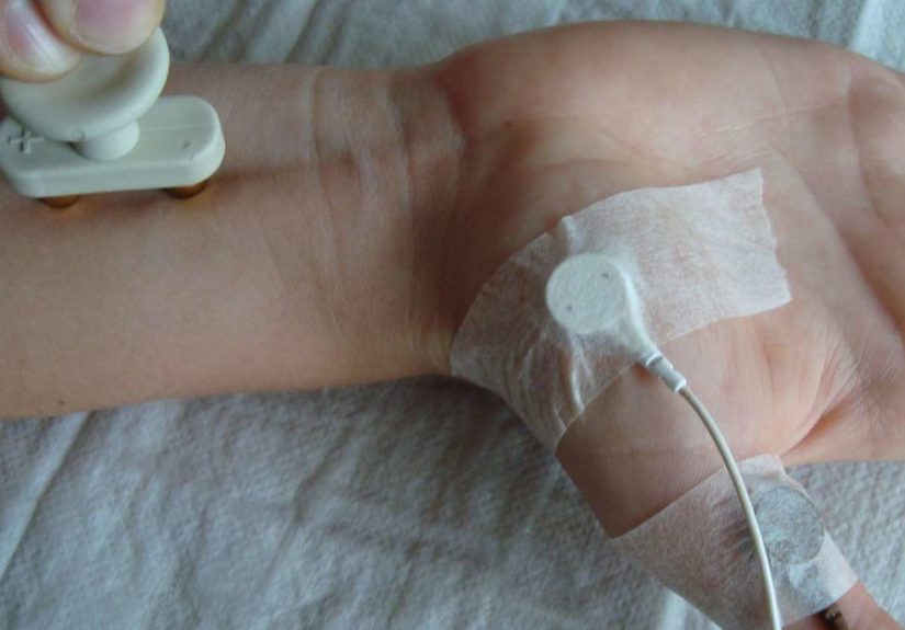 Nerve Conduction Velocity: Test, Purpose, and Results